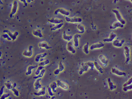 Infecție cu Naegleria fowleri (amibă care mănâncă creierul)