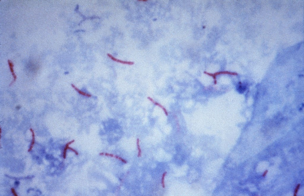 Mycobacterium tuberculosis Ziehl-Neelsen pata 02.jpg