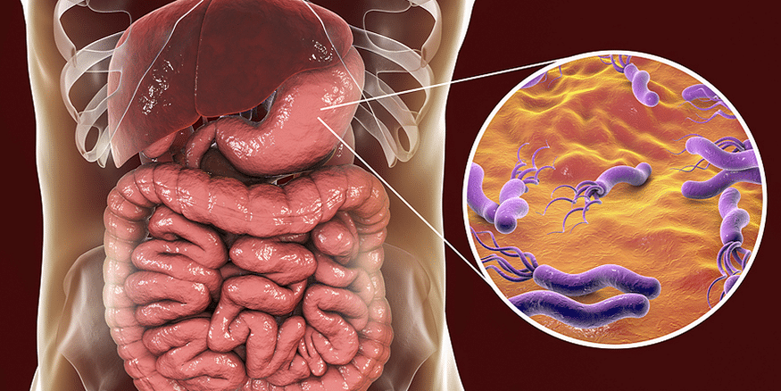 Infecția cu bacterii Helicobacter pylori (H. pylori)