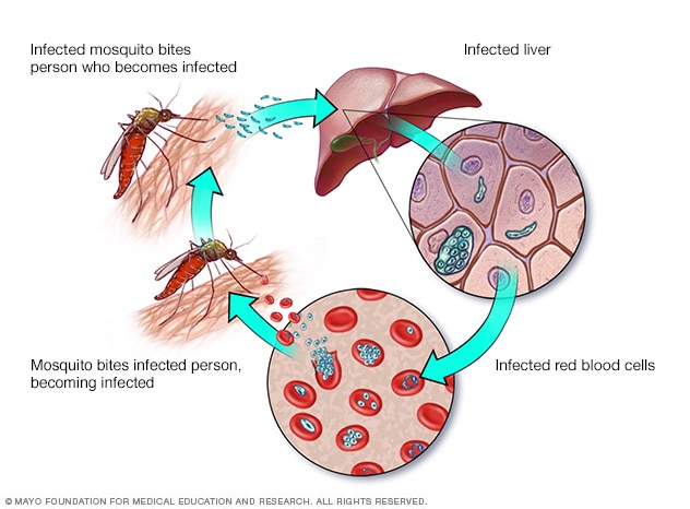 Malaria: cauze, simptome și tratament