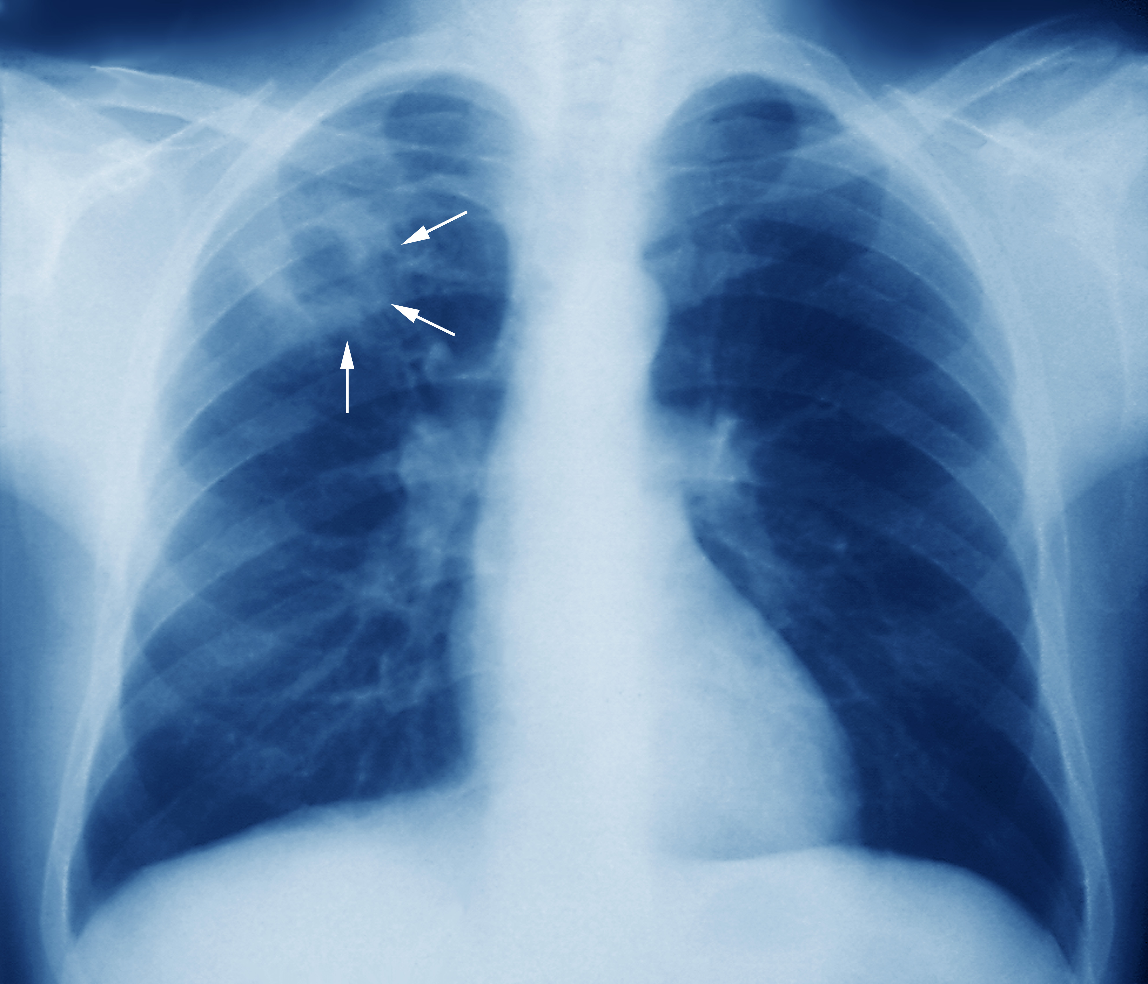 https://medro.org/wp-content/uploads/2020/12/m2700245-tuberculosis-chest-x-ray-science-photo-library-high.jpg