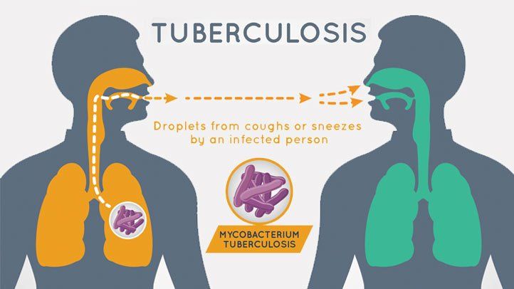 Tuberculoza: cauze, simptome și tratament