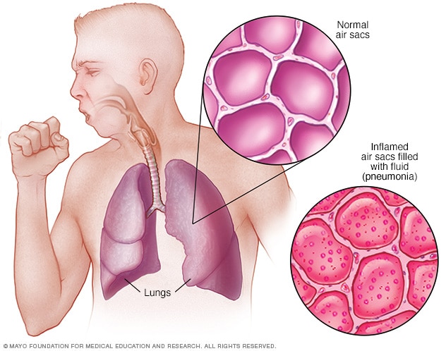 Pneumonie: cauze, simptome și tratament
