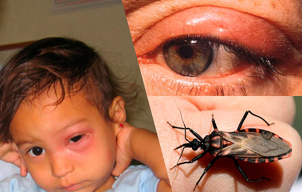 Boala Chagas: simptome, cauze și tratament