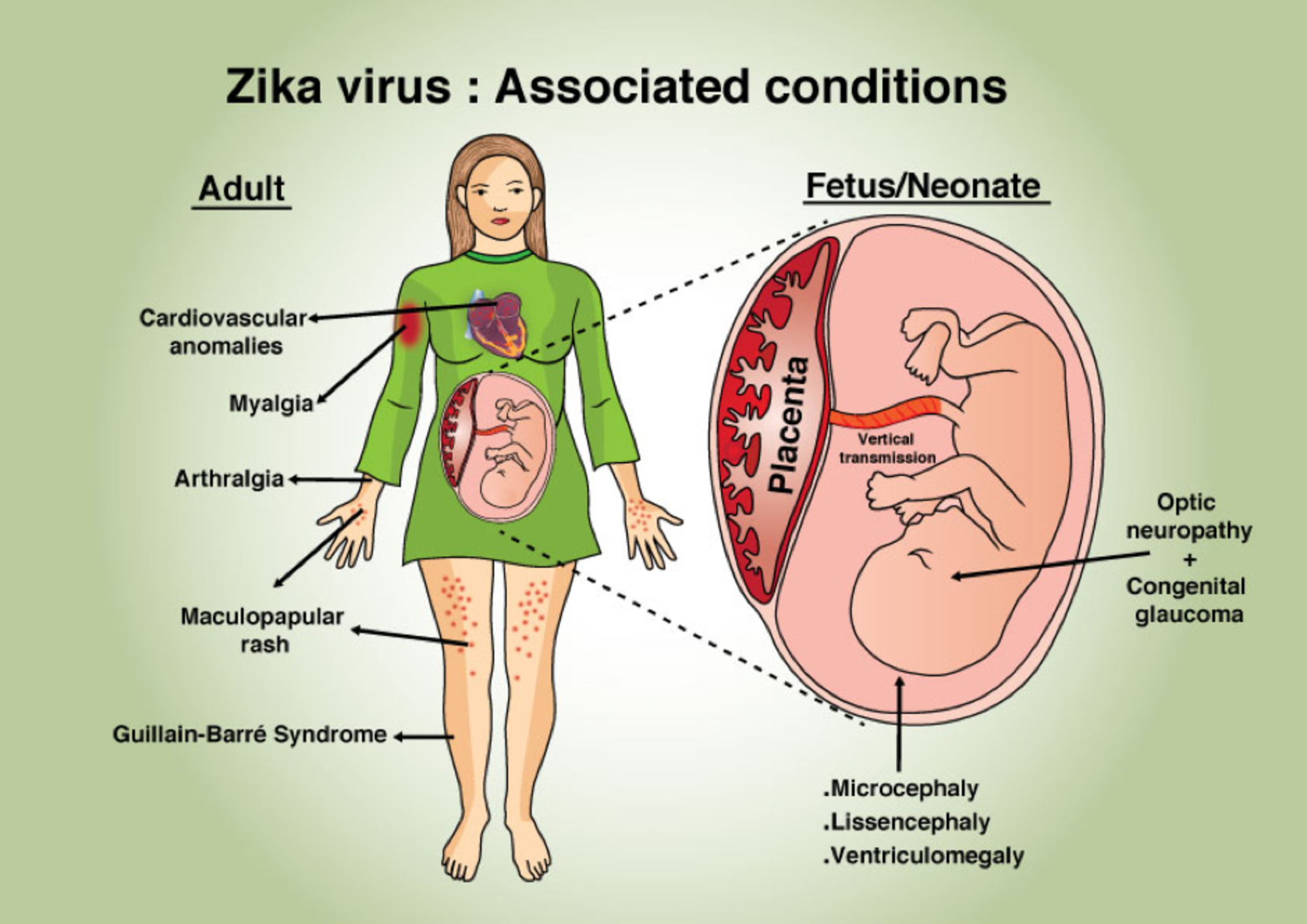 Complicații ale infecției cu virusul Zika